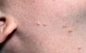 The Picture Untold: Unveiling the Unseen Stages of Molluscum Contagiosum
