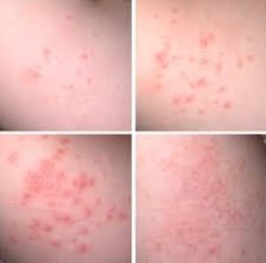The Picture Untold: Unveiling the Unseen Stages of Molluscum Contagiosum