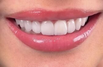 Invisalign & Clear Aligners in Kochi: Straighten Teeth Without Braces