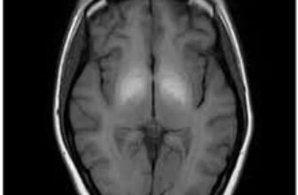 What Can a Brain MRI Really Reveal? The Scan Every Patient Should Know About
