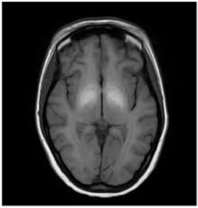 What Can a Brain MRI Really Reveal? The Scan Every Patient Should Know About