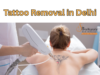Tattoo Removal Treatment in Delhi