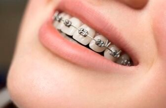 Adult Orthodontics in Kochi — Why Your 30s, 40s, and Beyond Are a Great Time to Align Your Teeth