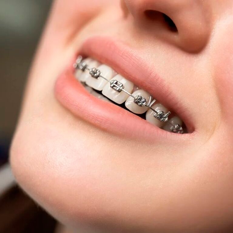 Adult Orthodontics in Kochi — Why Your 30s, 40s, and Beyond Are a Great Time to Align Your Teeth