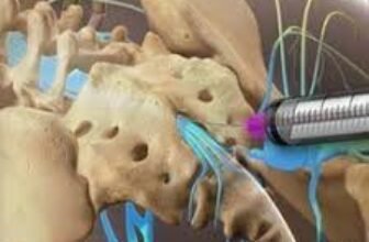 How Can Facet Joint Injections in the UK Help Relieve Back Pain?