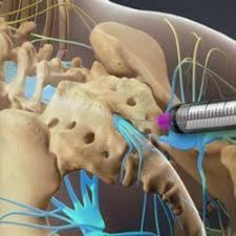 How Can Facet Joint Injections in the UK Help Relieve Back Pain?