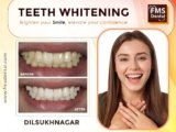 Teeth Whitening Treatment in Dilsukhnagar – Brighten Your Smile with FMS Dental