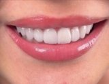 Invisalign & Clear Aligners in Kochi: Straighten Teeth Without Braces