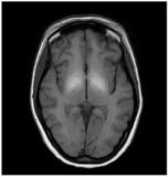 What Can a Brain MRI Really Reveal? The Scan Every Patient Should Know About