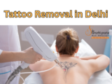 Tattoo Removal Treatment in Delhi