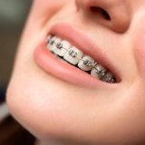Adult Orthodontics in Kochi — Why Your 30s, 40s, and Beyond Are a Great Time to Align Your Teeth